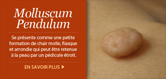 Molluscum Pendulum